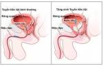 Thực phẩm phòng ngừa ung thư tuyến tiền liệt